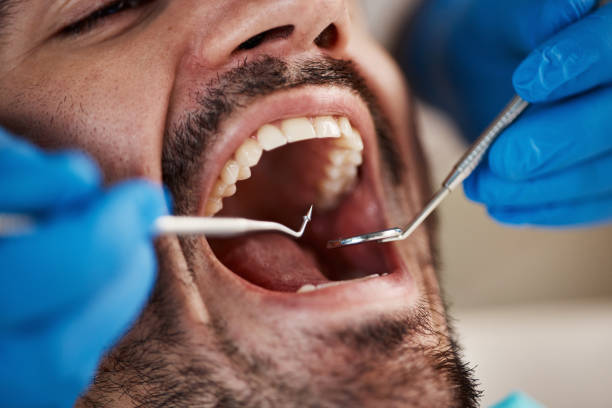 Best Emergency Wisdom Teeth Removal in Eden, TX