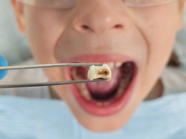 Best Emergency Tooth Extraction in Eden, TX